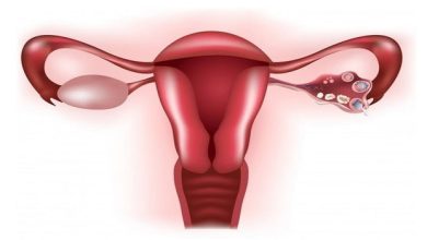 Endometriozis (çikolata kisti) nedir? Neden olur, nasıl tedavi edilir?