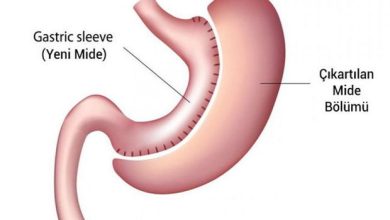 Tüp mide ameliyatı nedir?
